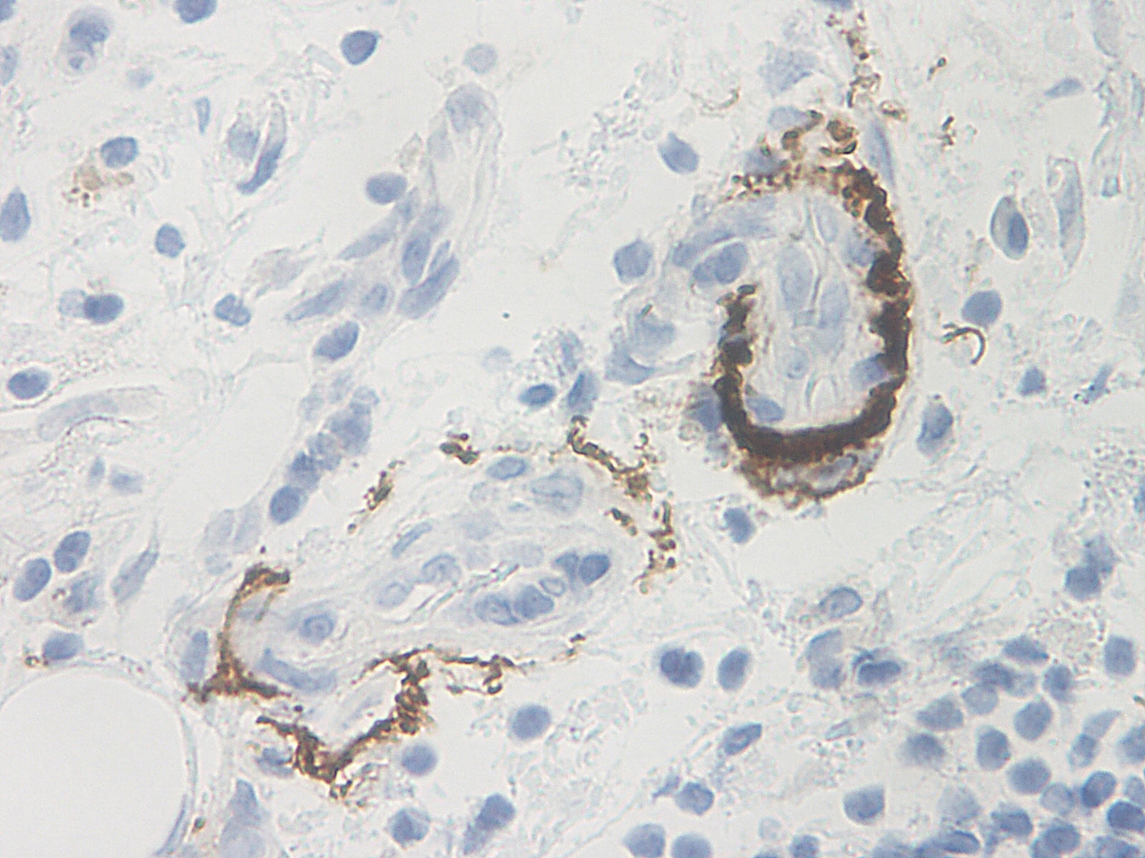 This antibody stained formalin-fixed, paraffin-embedded sections of human pancreas adenocarcinoma.  The recommended concentration is 2.5 ug/ml with an overnight incubation at 4°C.  An HRP-labeled polymer detection system was used with a DAB chromogen.  He