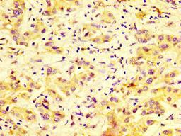 IHC image of CSB-PA859528LA01HU diluted at 1:600 and staining in paraffin-embedded human liver cancer performed on a Leica BondTM system. After dewaxing and hydration, antigen retrieval was mediated by high pressure in a citrate buffer (pH 6.0). Section was blocked with 10% normal goat serum 30min at RT. Then primary antibody (1% BSA) was incubated at 4&deg;C overnight. The primary is detected by a biotinylated secondary antibody and visualized using an HRP conjugated SP system.