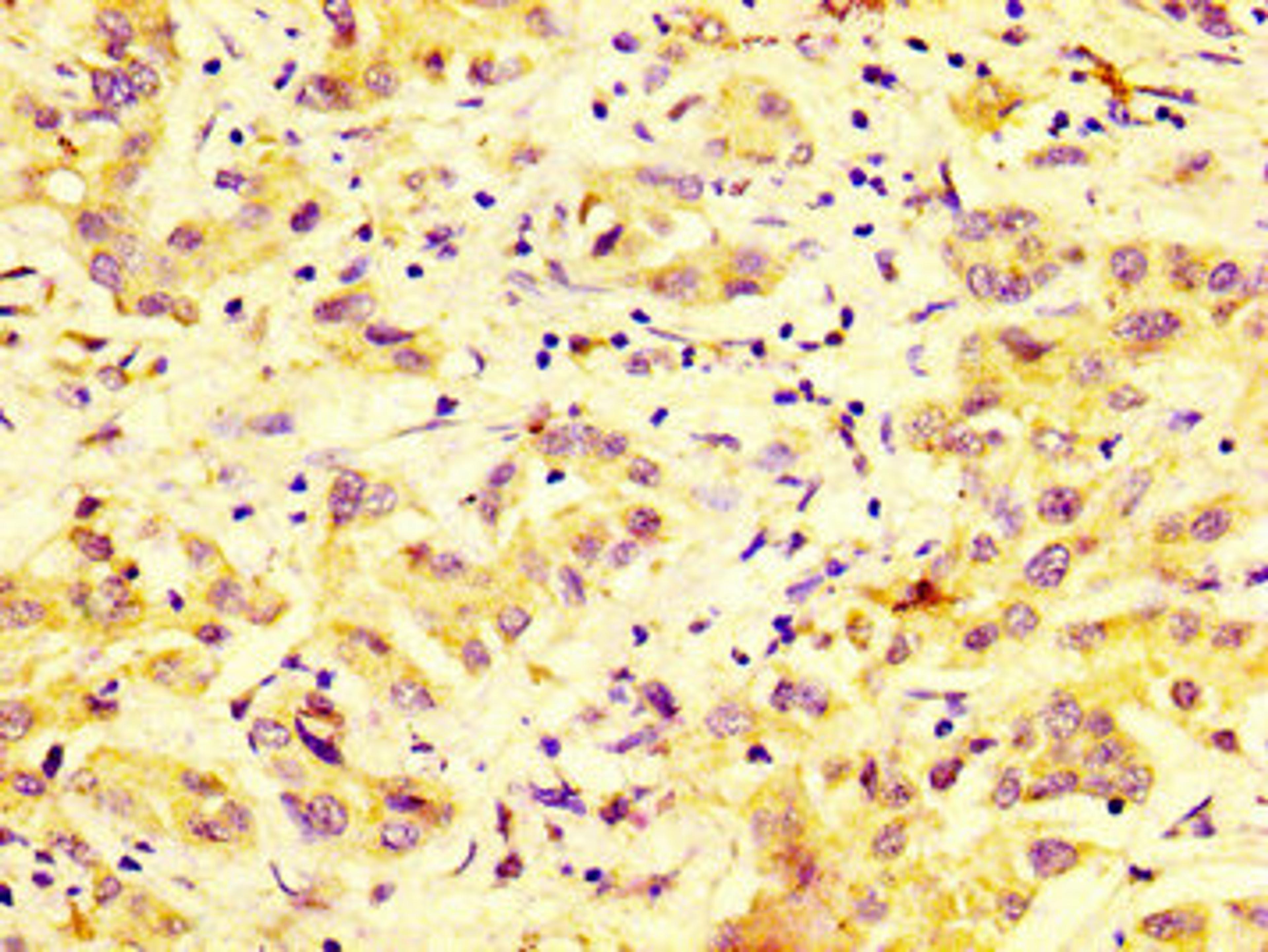IHC image of CSB-PA859528LA01HU diluted at 1:600 and staining in paraffin-embedded human liver cancer performed on a Leica BondTM system. After dewaxing and hydration, antigen retrieval was mediated by high pressure in a citrate buffer (pH 6.0). Section was blocked with 10% normal goat serum 30min at RT. Then primary antibody (1% BSA) was incubated at 4&deg;C overnight. The primary is detected by a biotinylated secondary antibody and visualized using an HRP conjugated SP system.