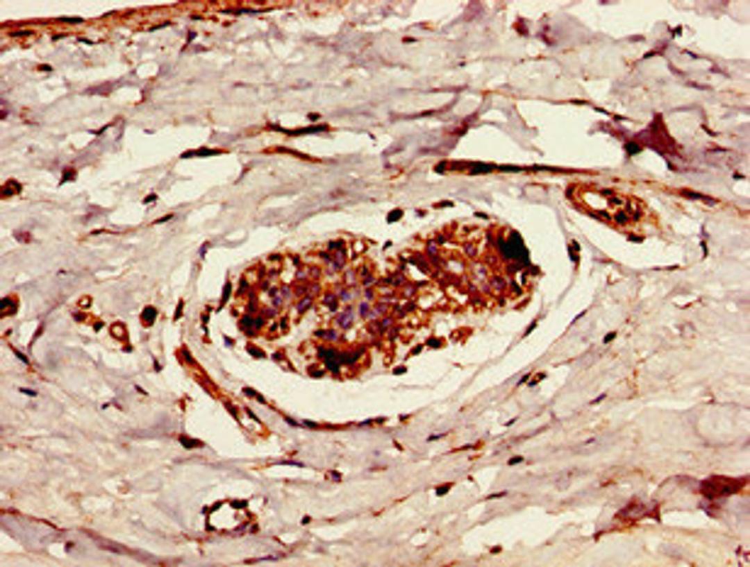 Immunohistochemistry of paraffin-embedded human breast cancer using CSB-PA865105LA01HU at dilution of 1:100