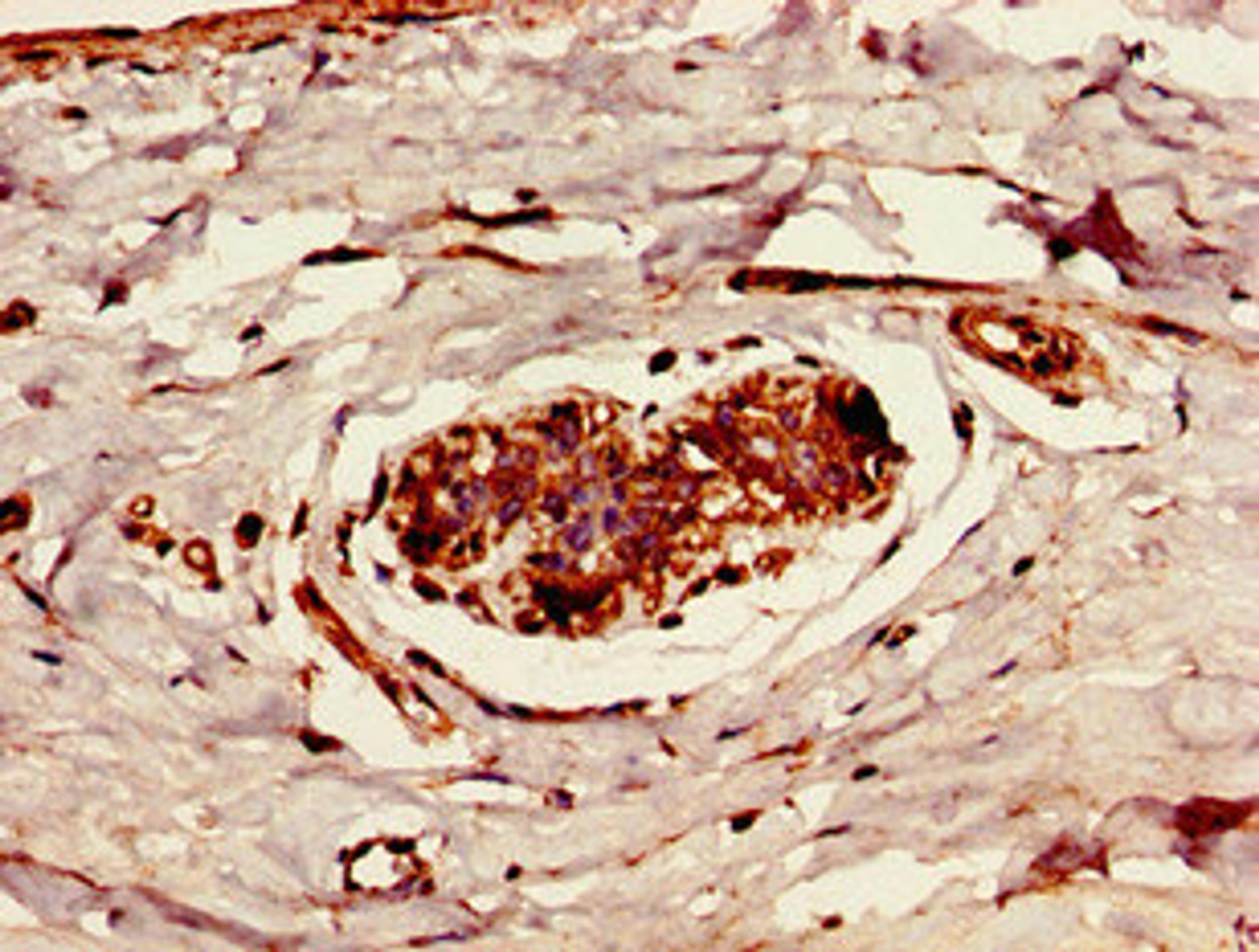 Immunohistochemistry of paraffin-embedded human breast cancer using CSB-PA865105LA01HU at dilution of 1:100