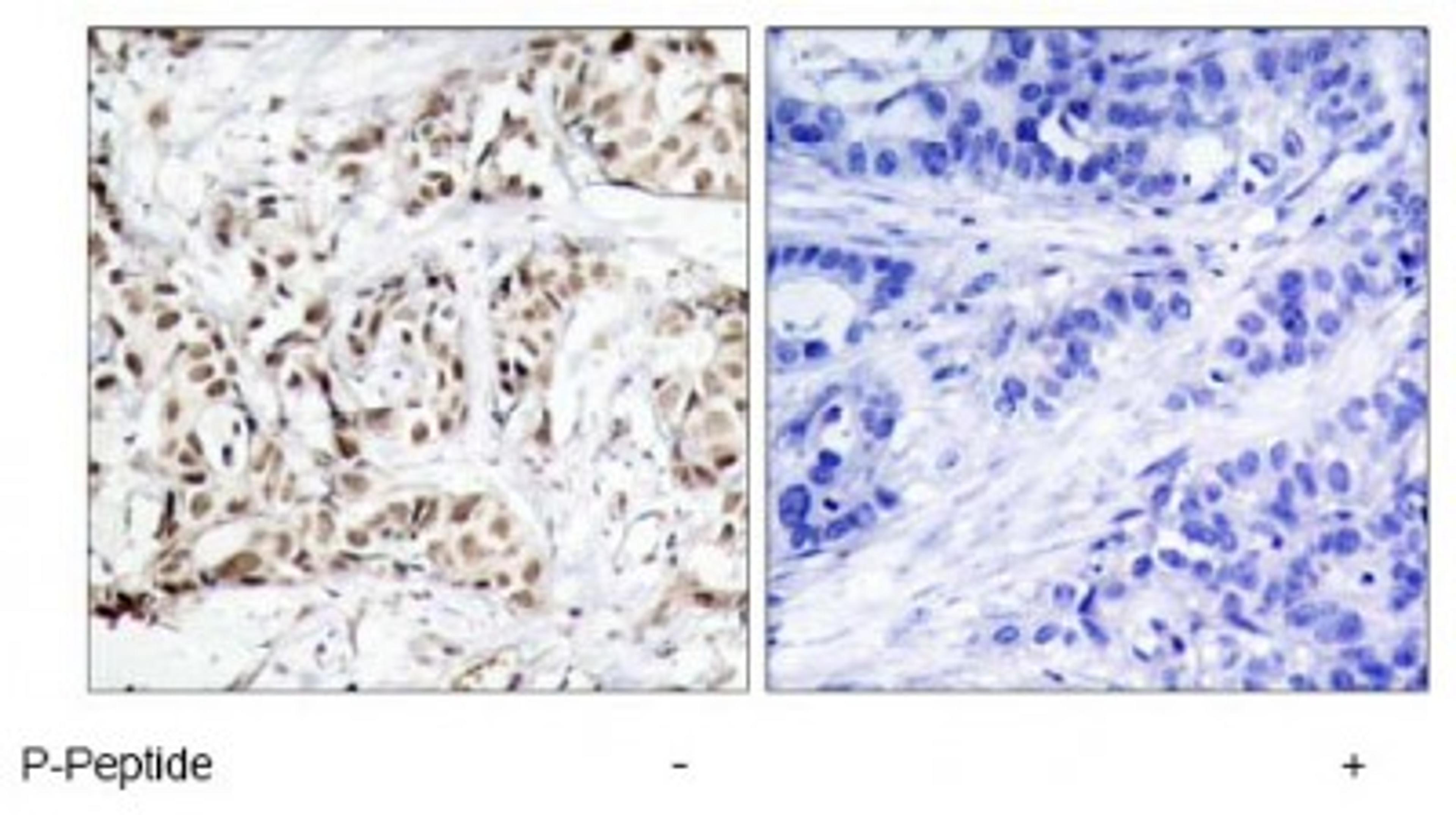 Immunohistochemistry: JNK1 [p Thr183] Antibody [NB100-82009] - Immunohistochemical analysis of paraffin-embedded human breast carcinoma tissue using SAPK/JNK (phospho-Thr183) antibody.