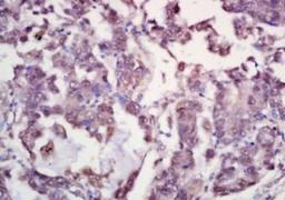 Immunohistochemical analysis of formalin-fixed paraffin embedded human laryngeal cancer tissue using BRD7 antibody (dilution at 1:200)