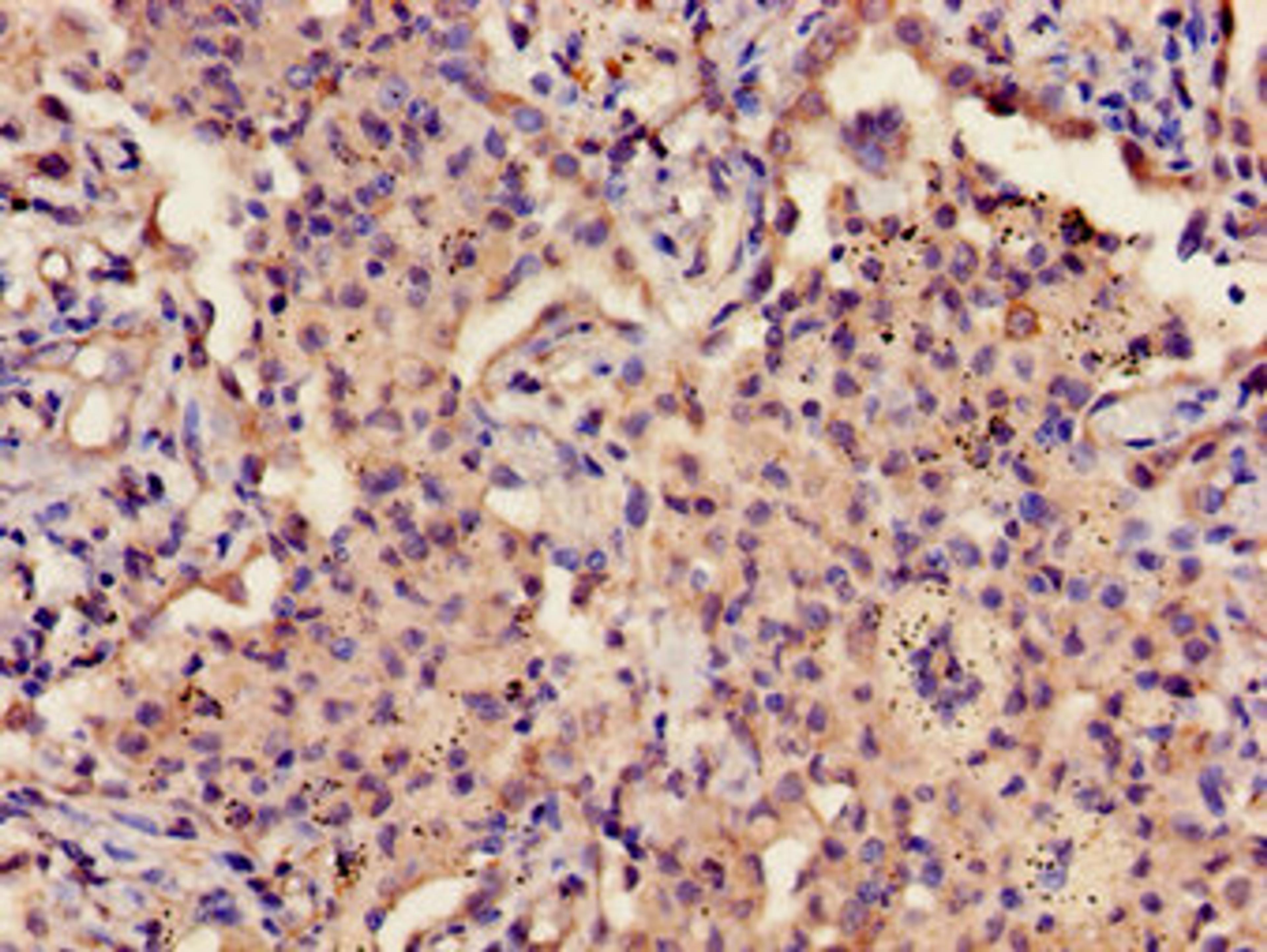 Immunohistochemistry of paraffin-embedded human lung cancer using CSB-PA009690LA01HU at dilution of 1:100