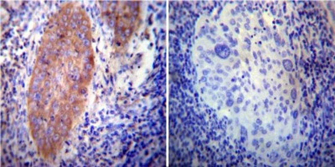 Immunohistochemistry-Paraffin: VAMP4 Antibody [NB300-533] - Both normal and cancer biopsies of deparaffinized human Cervical carcinoma tissue.