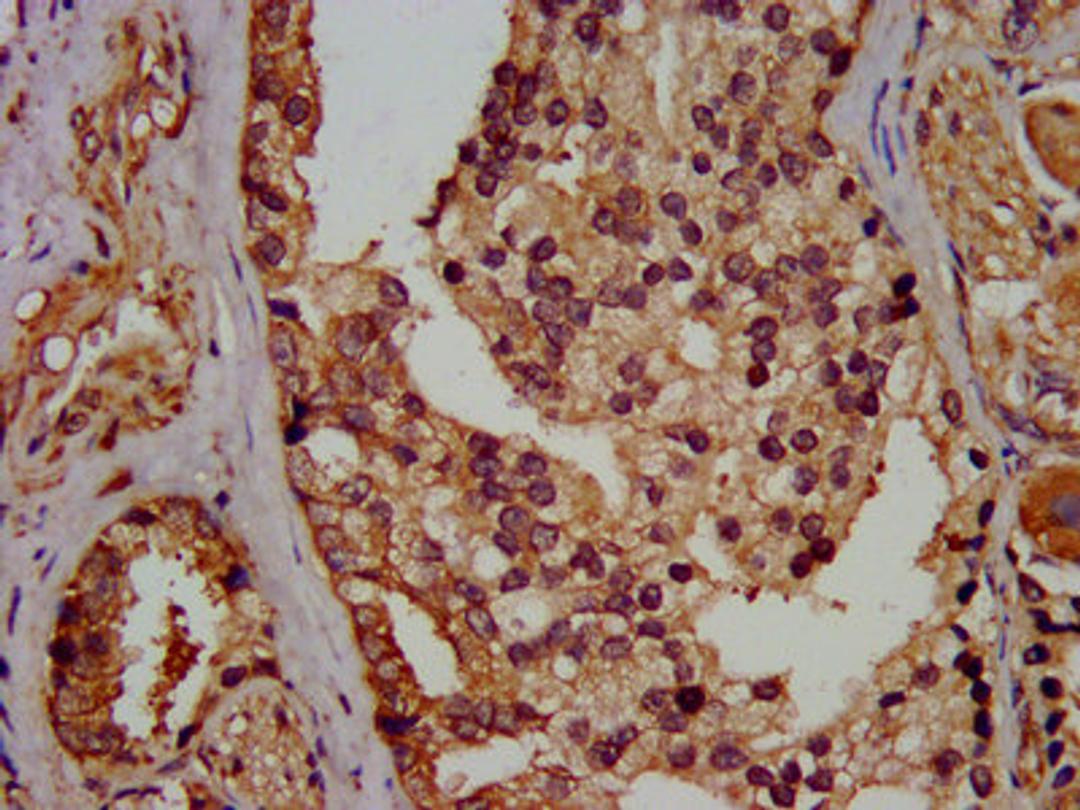 IHC image of CSB-PA03099A0Rb diluted at 1:400 and staining in paraffin-embedded human prostate cancer performed on a Leica BondTM system. After dewaxing and hydration, antigen retrieval was mediated by high pressure in a citrate buffer (pH 6.0). Section was blocked with 10% normal goat serum 30min at RT. Then primary antibody (1% BSA) was incubated at 4°C overnight. The primary is detected by a biotinylated secondary antibody and visualized using an HRP conjugated SP system.