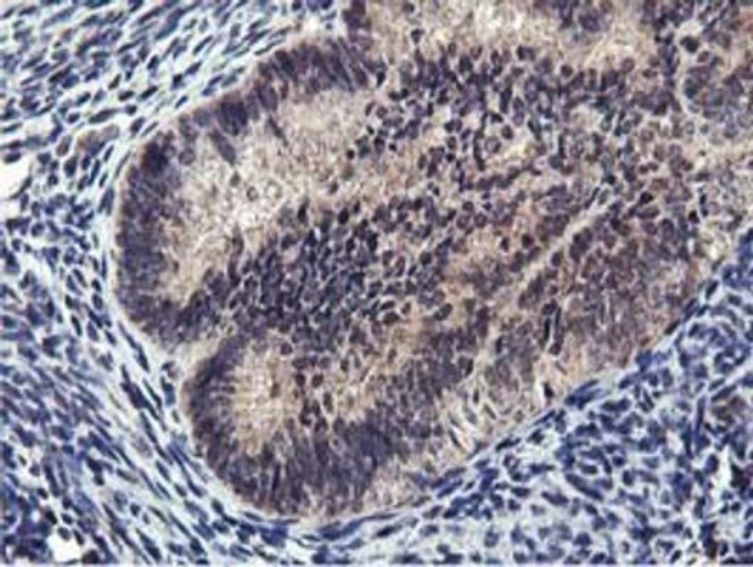 Immunohistochemistry-Paraffin: MIER2 Antibody (3G7) [NBP2-01748] - Staining of paraffin-embedded Adenocarcinoma of Human endometrium tissue using anti-MIER2 mouse monoclonal antibody.