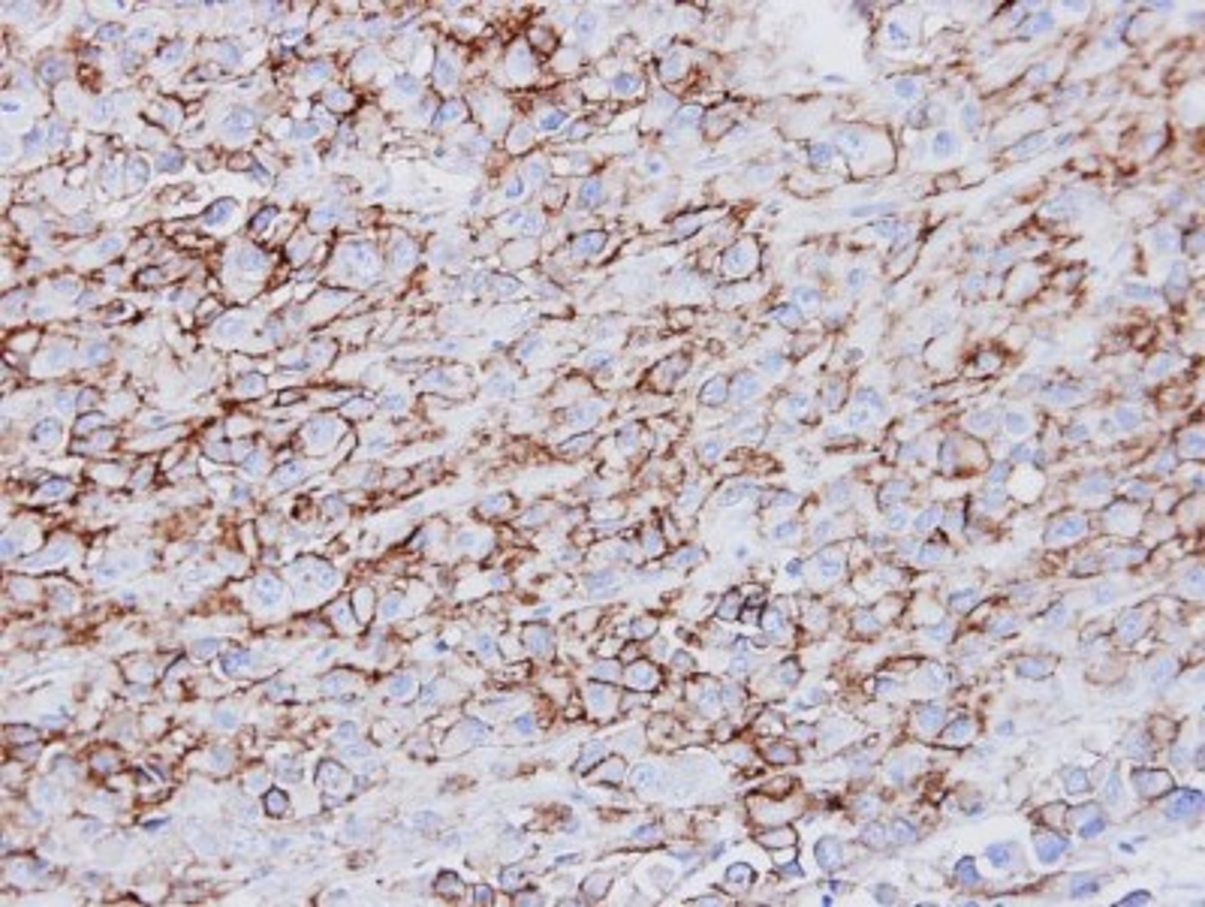 Immunohistochemistry-Paraffin: HLA DRA Antibody [NBP1-33458] - Paraffin-embedded MDA-MB-231 xenograft, using antibody at 1:500 dilution.