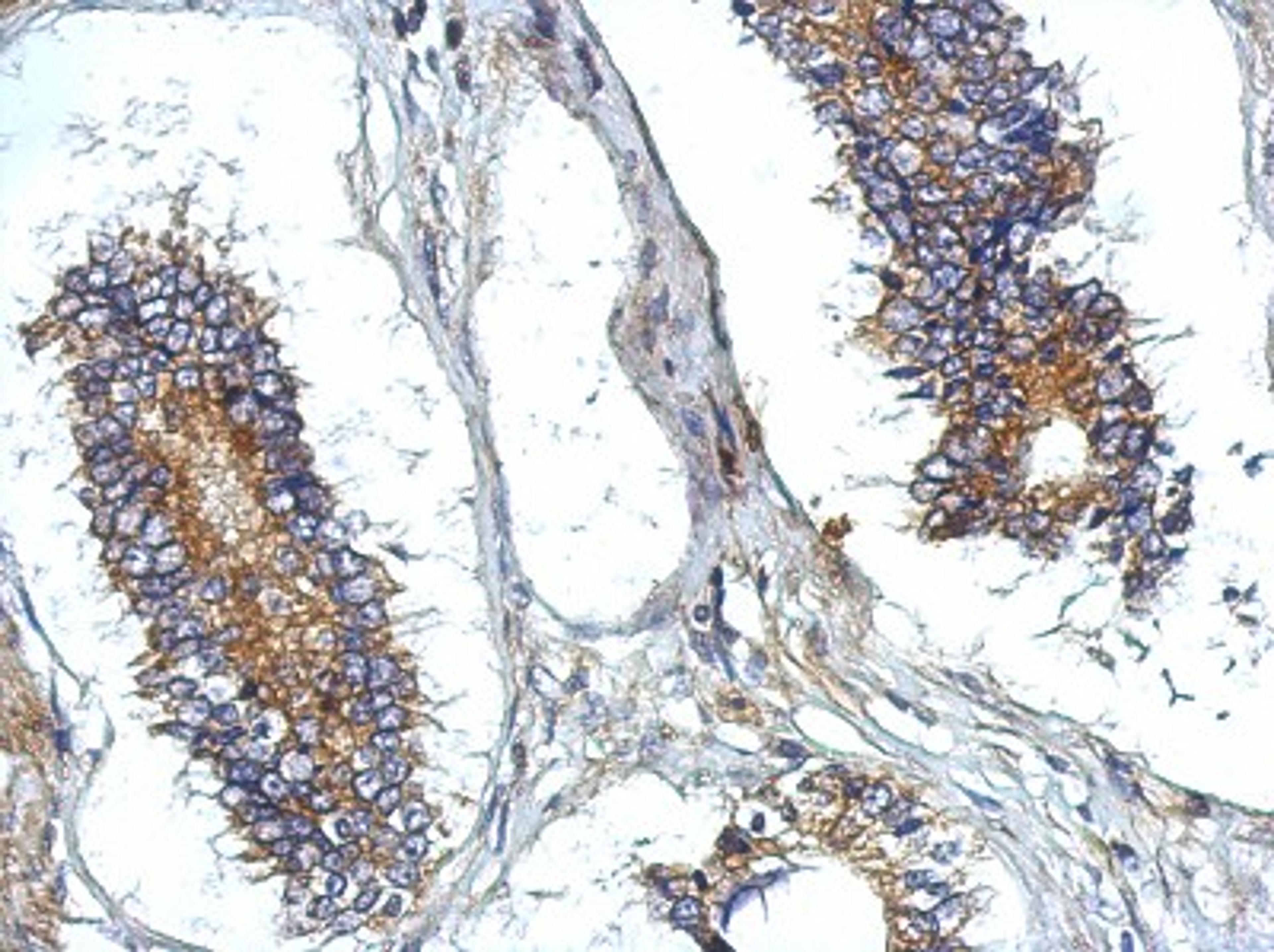 Immunohistochemistry-Paraffin: ATG13 Antibody [NBP2-15502] - Immunohistochemical analysis of paraffin-embedded Gastric ca, using antibody at 1:500 dilution.