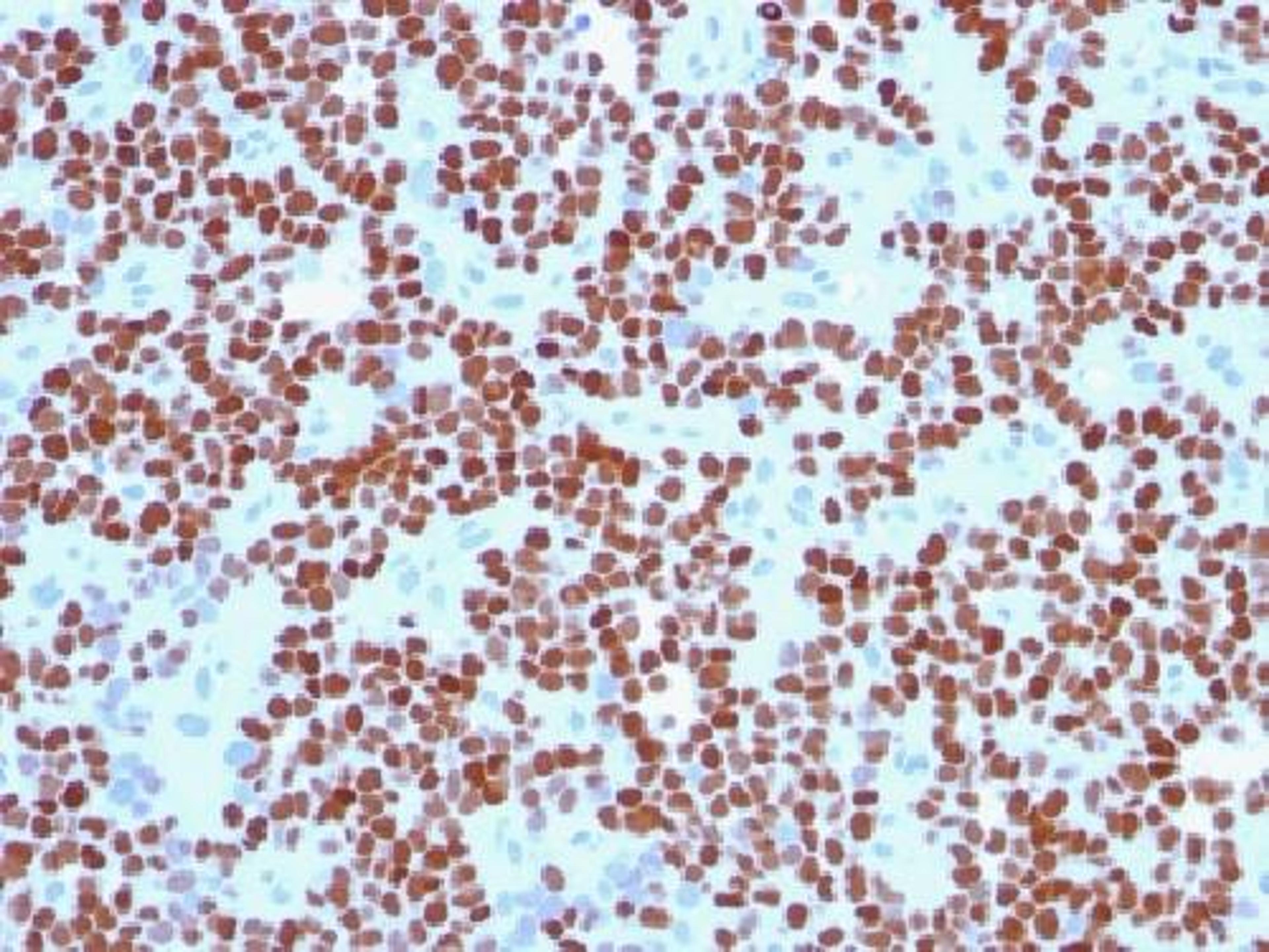 Immunohistochemical staining of human Ewing's Sarcoma tissue using NKX2-2 antibody