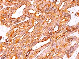 Immunohistochemistry-Paraffin: Cytokeratin, pan Antibody (SPM115 + SPM116) [NBP2-34347] - Formalin-paraffin colon carcinoma stained with pan Cytokeratin Ab cocktail (SPM115+SPM116).