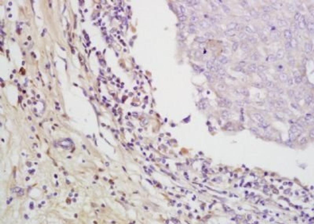 Immunohistochemical analysis of formalin-fixed paraffin embedded Human lung cancer tissue using EMR1 antibody (dilution at 1:200)