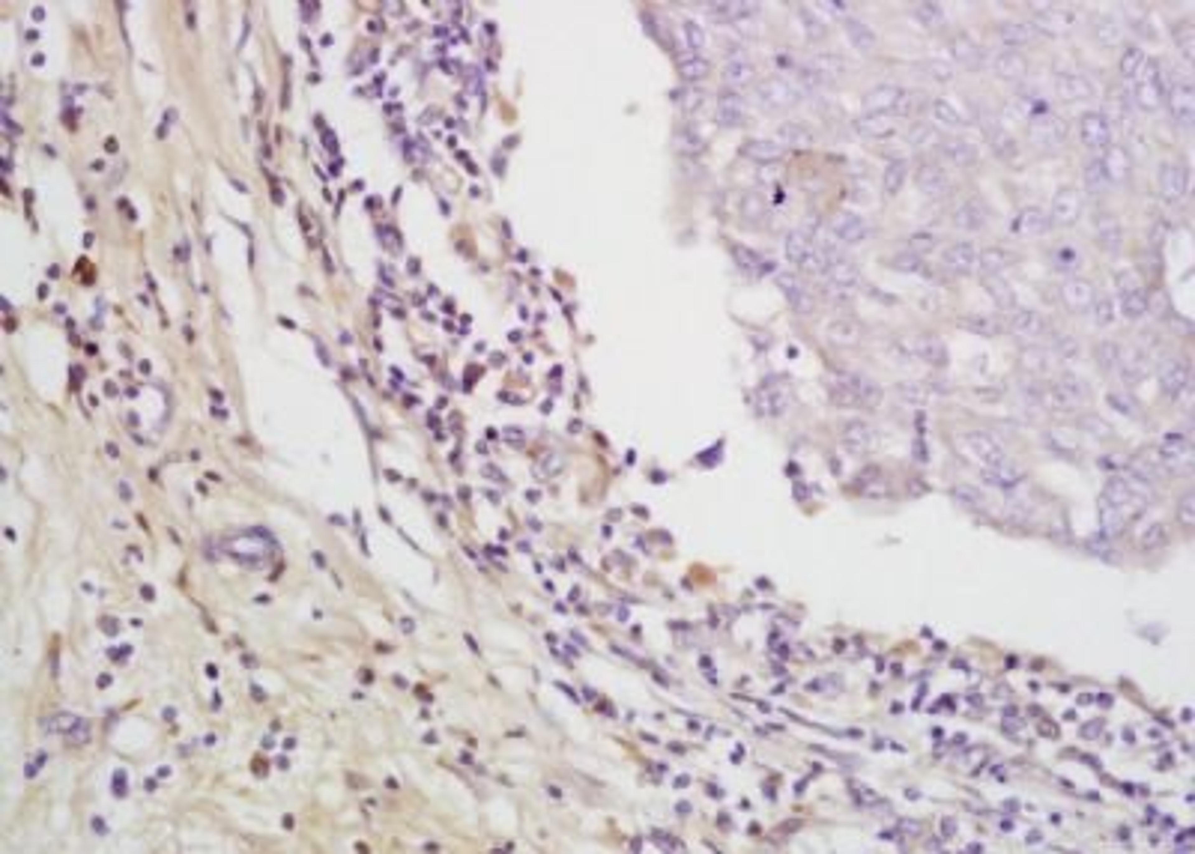 Immunohistochemical analysis of formalin-fixed paraffin embedded Human lung cancer tissue using EMR1 antibody (dilution at 1:200)