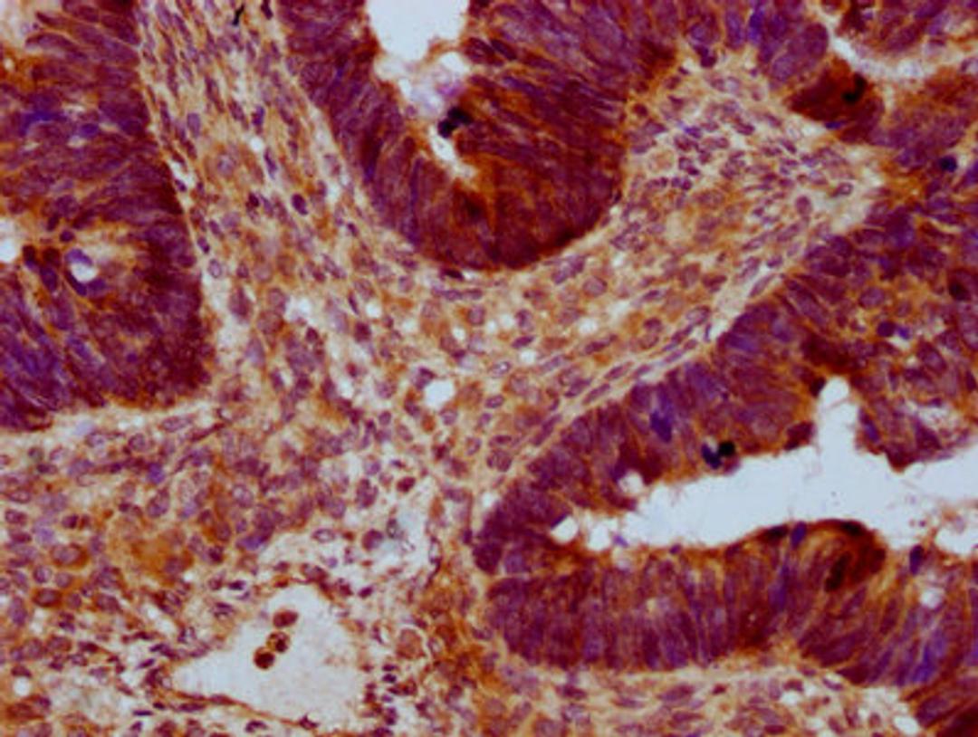 IHC image of CSB-PA891733LA01HU diluted at 1:400 and staining in paraffin-embedded human ovarian cancer performed on a Leica BondTM system. After dewaxing and hydration, antigen retrieval was mediated by high pressure in a citrate buffer (pH 6.0). Section was blocked with 10% normal goat serum 30min at RT. Then primary antibody (1% BSA) was incubated at 4°C overnight. The primary is detected by a biotinylated secondary antibody and visualized using an HRP conjugated SP system.