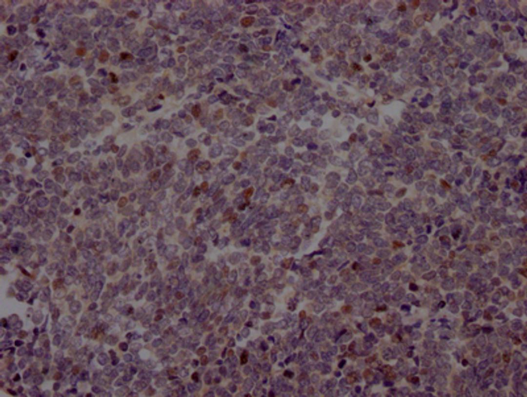IHC image of CSB-RA942183A0HU diluted at 1:100 and staining in paraffin-embedded human lung cancer performed on a Leica BondTM system. After dewaxing and hydration, antigen retrieval was mediated by high pressure in a citrate buffer (pH 6.0). Section was blocked with 10% normal goat serum 30min at RT. Then primary antibody (1% BSA) was incubated at 4℃ overnight. The primary is detected by a Goat anti-rabbit IgG polymer labeled by HRP and visualized using 0.05% DAB.