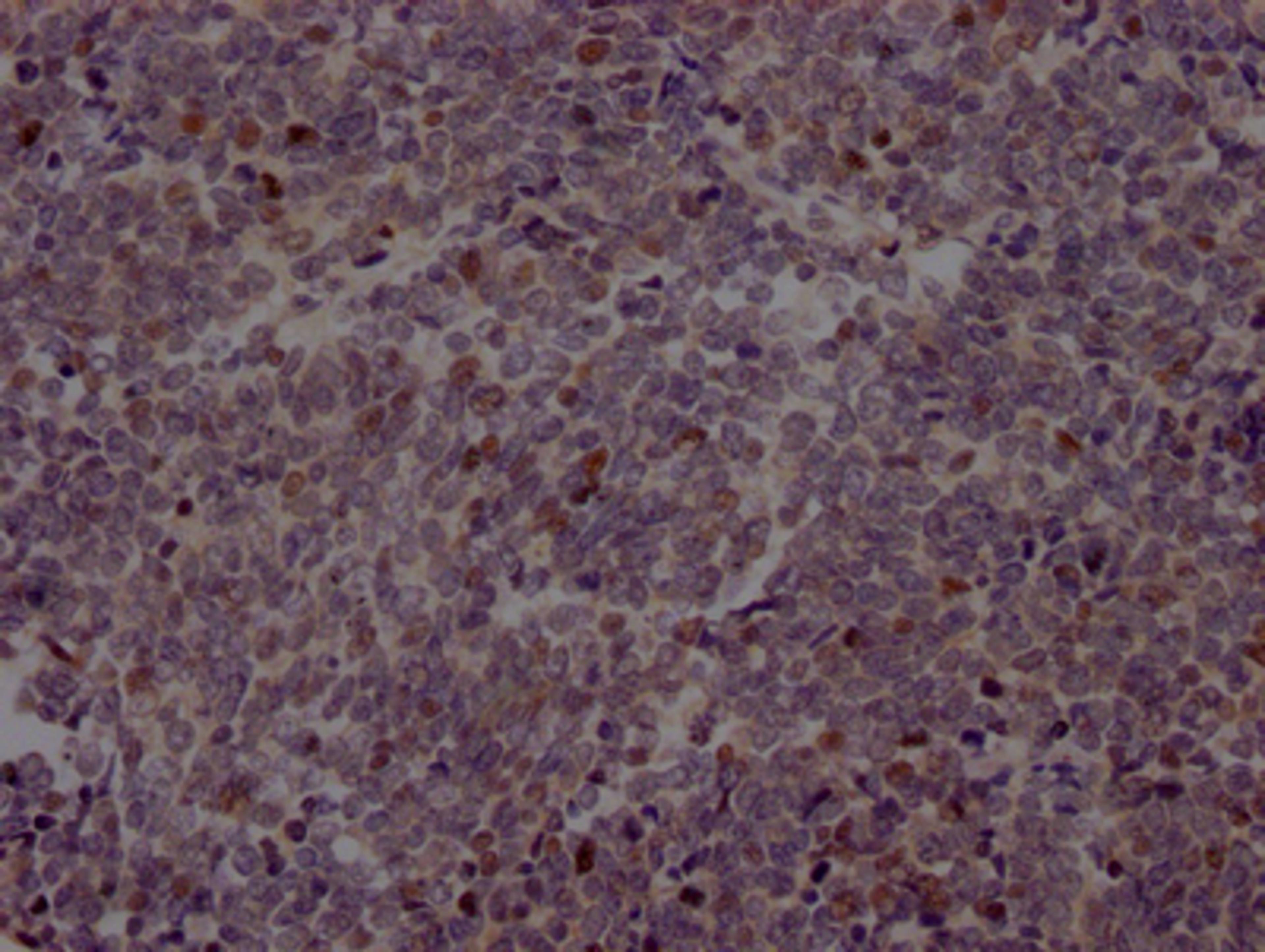 IHC image of CSB-RA942183A0HU diluted at 1:100 and staining in paraffin-embedded human lung cancer performed on a Leica BondTM system. After dewaxing and hydration, antigen retrieval was mediated by high pressure in a citrate buffer (pH 6.0). Section was blocked with 10% normal goat serum 30min at RT. Then primary antibody (1% BSA) was incubated at 4℃ overnight. The primary is detected by a Goat anti-rabbit IgG polymer labeled by HRP and visualized using 0.05% DAB.