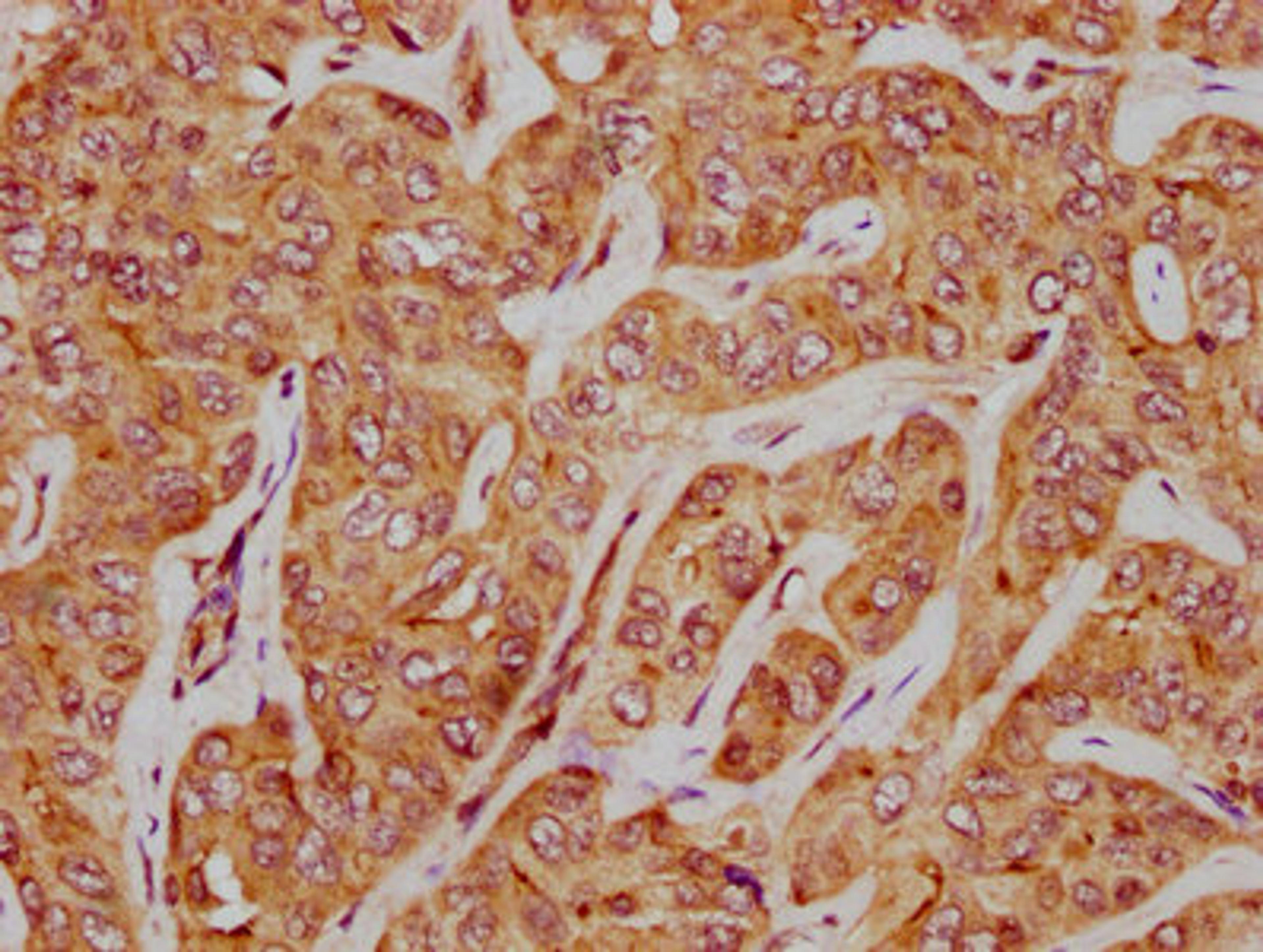 IHC image of CSB-PA021596LA01HU diluted at 1:500 and staining in paraffin-embedded human liver cancer performed on a Leica BondTM system. After dewaxing and hydration, antigen retrieval was mediated by high pressure in a citrate buffer (pH 6.0). Section was blocked with 10% normal goat serum 30min at RT. Then primary antibody (1% BSA) was incubated at 4&deg;C overnight. The primary is detected by a biotinylated secondary antibody and visualized using an HRP conjugated SP system.