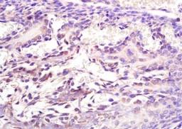 Immunohistochemical analysis of formalin-fixed paraffin embedded human lung carcinoma tissue using ADAMTS9 antibody (dilution at 1:200)