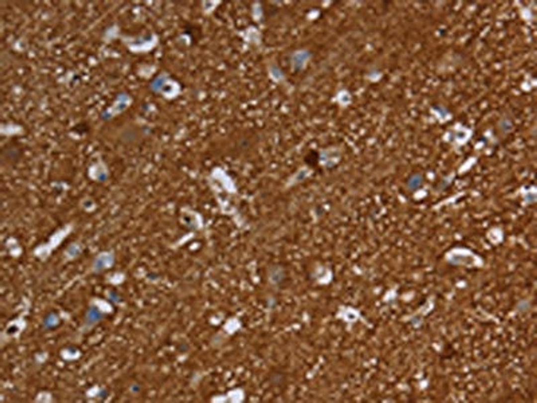 The image is immunohistochemistry of paraffin-embedded Human brain tissue using CSB-PA580970(SNCG Antibody) at dilution 1/60. (Original magnification: ×200)