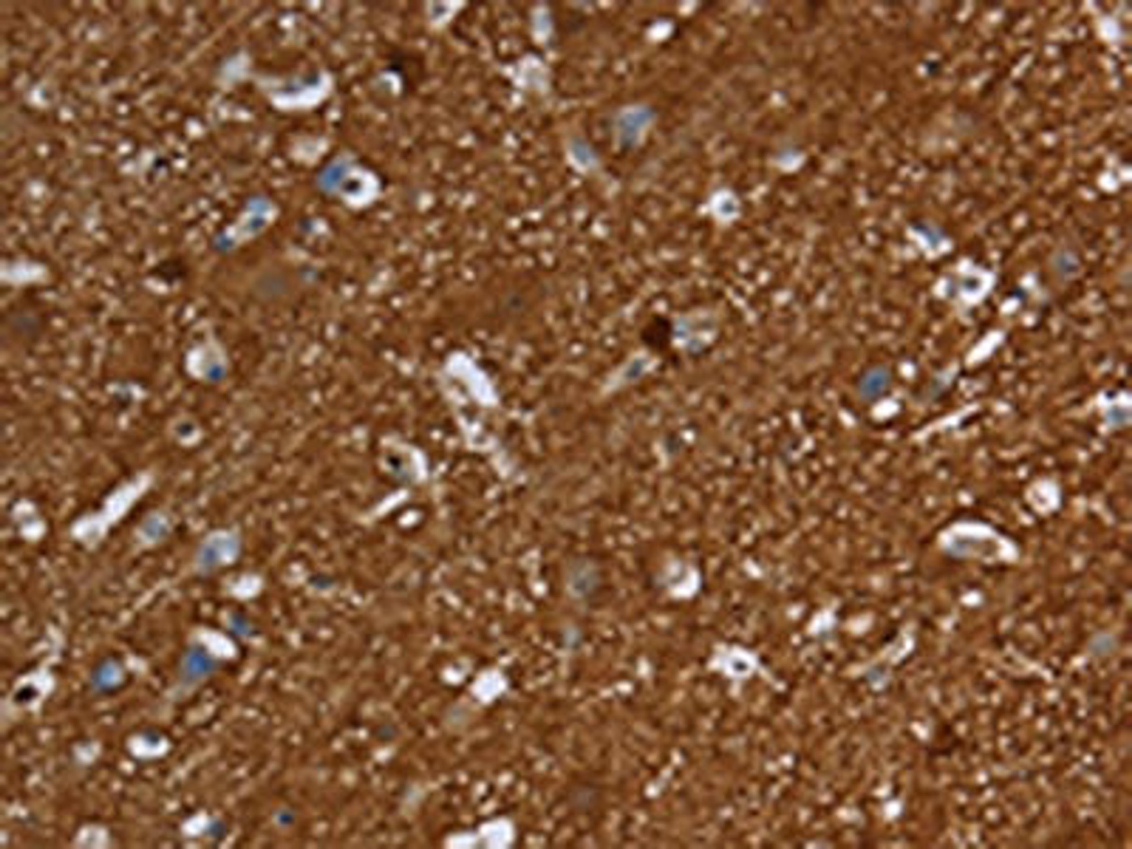 The image is immunohistochemistry of paraffin-embedded Human brain tissue using CSB-PA580970(SNCG Antibody) at dilution 1/60. (Original magnification: ×200)