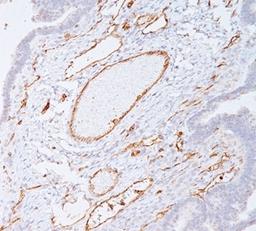 IHC staining of colon carcinoma with PECAM-1 antibody (C31.7). Note cell membrane staining of endothelial cells.