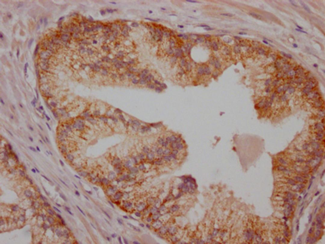 IHC image of CSB-RA171021A0HU diluted at 1:100 and staining in paraffin-embedded human prostate cancer performed on a Leica BondTM system. After dewaxing and hydration, antigen retrieval was mediated by high pressure in a citrate buffer (pH 6.0). Section was blocked with 10% normal goat serum 30min at RT. Then primary antibody (1% BSA) was incubated at 4℃ overnight. The primary is detected by a Goat anti-rabbit IgG polymer labeled by HRP and visualized using 0.05% DAB.
