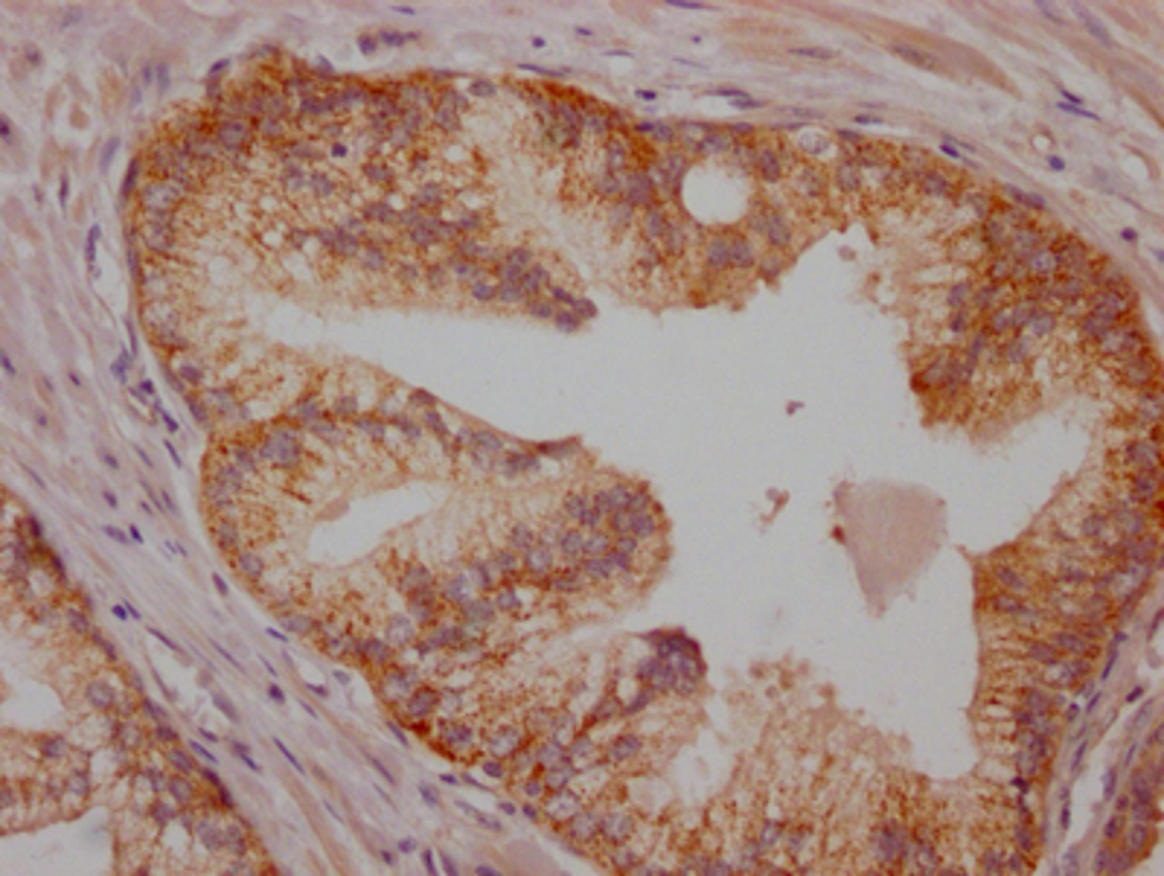 IHC image of CSB-RA171021A0HU diluted at 1:100 and staining in paraffin-embedded human prostate cancer performed on a Leica BondTM system. After dewaxing and hydration, antigen retrieval was mediated by high pressure in a citrate buffer (pH 6.0). Section was blocked with 10% normal goat serum 30min at RT. Then primary antibody (1% BSA) was incubated at 4℃ overnight. The primary is detected by a Goat anti-rabbit IgG polymer labeled by HRP and visualized using 0.05% DAB.