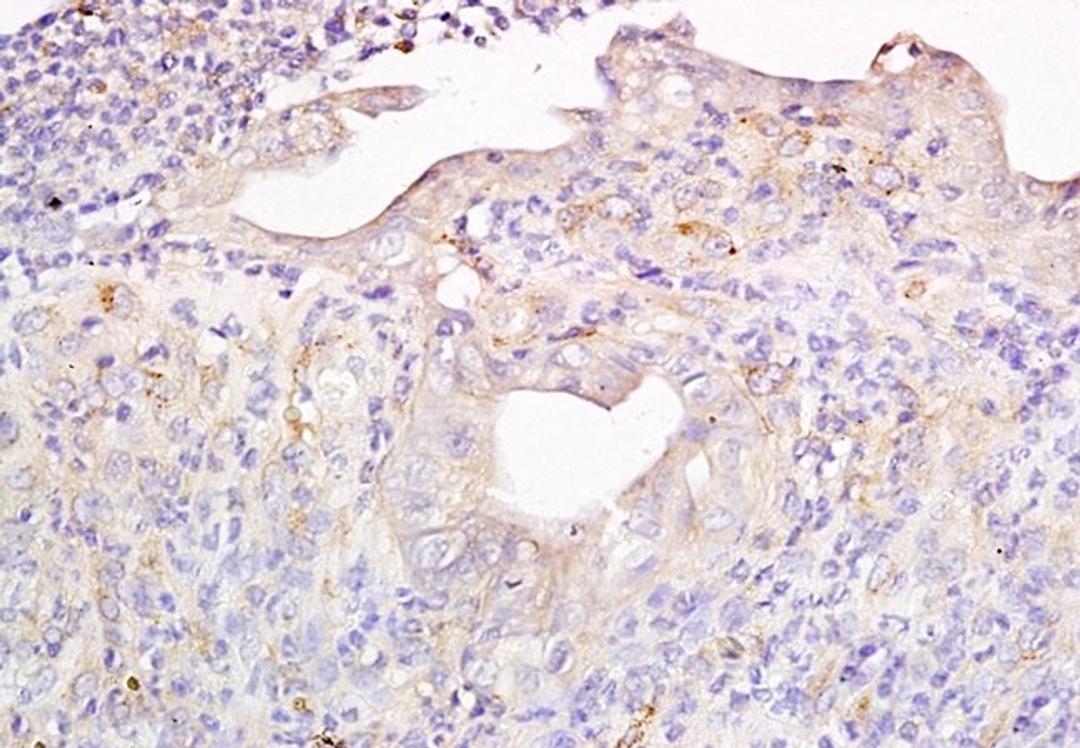 Immunohistochemical analysis of formalin-fixed and paraffin-embedded mouse colon carcinoma tissue using Metallothionein antibody (dilution at: 1:200)