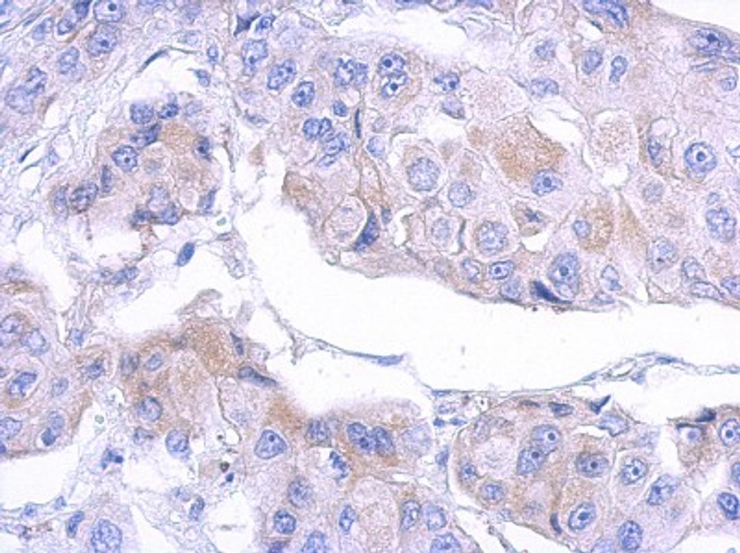 Immunohistochemistry-Paraffin: MTMR12 Antibody [NBP2-19432] - Immunohistochemical analysis of paraffin-embedded breast ca, using antibody at 1:500 dilution.