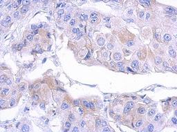 Immunohistochemistry-Paraffin: MTMR12 Antibody [NBP2-19432] - Immunohistochemical analysis of paraffin-embedded breast ca, using antibody at 1:500 dilution.