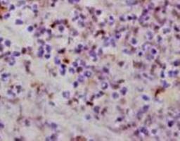 Immunohistochemical staining of Human brain glioma tissue using APC antibody.