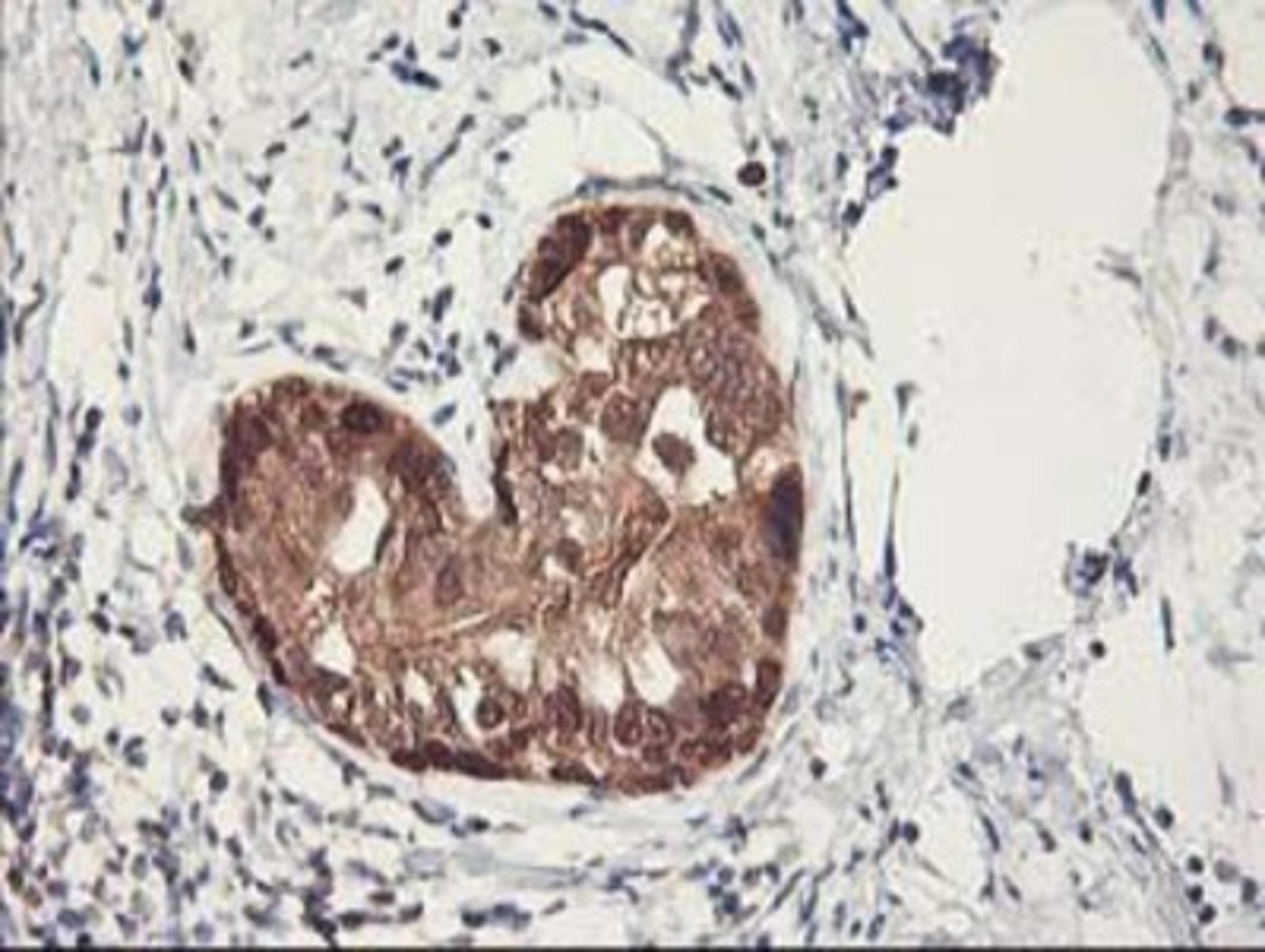 Immunohistochemistry-Paraffin: RbAp46 Antibody (5A4) [NBP2-01308] - Staining of paraffin-embedded Adenocarcinoma of Human breast tissue using anti-RbAp46 mouse monoclonal antibody.