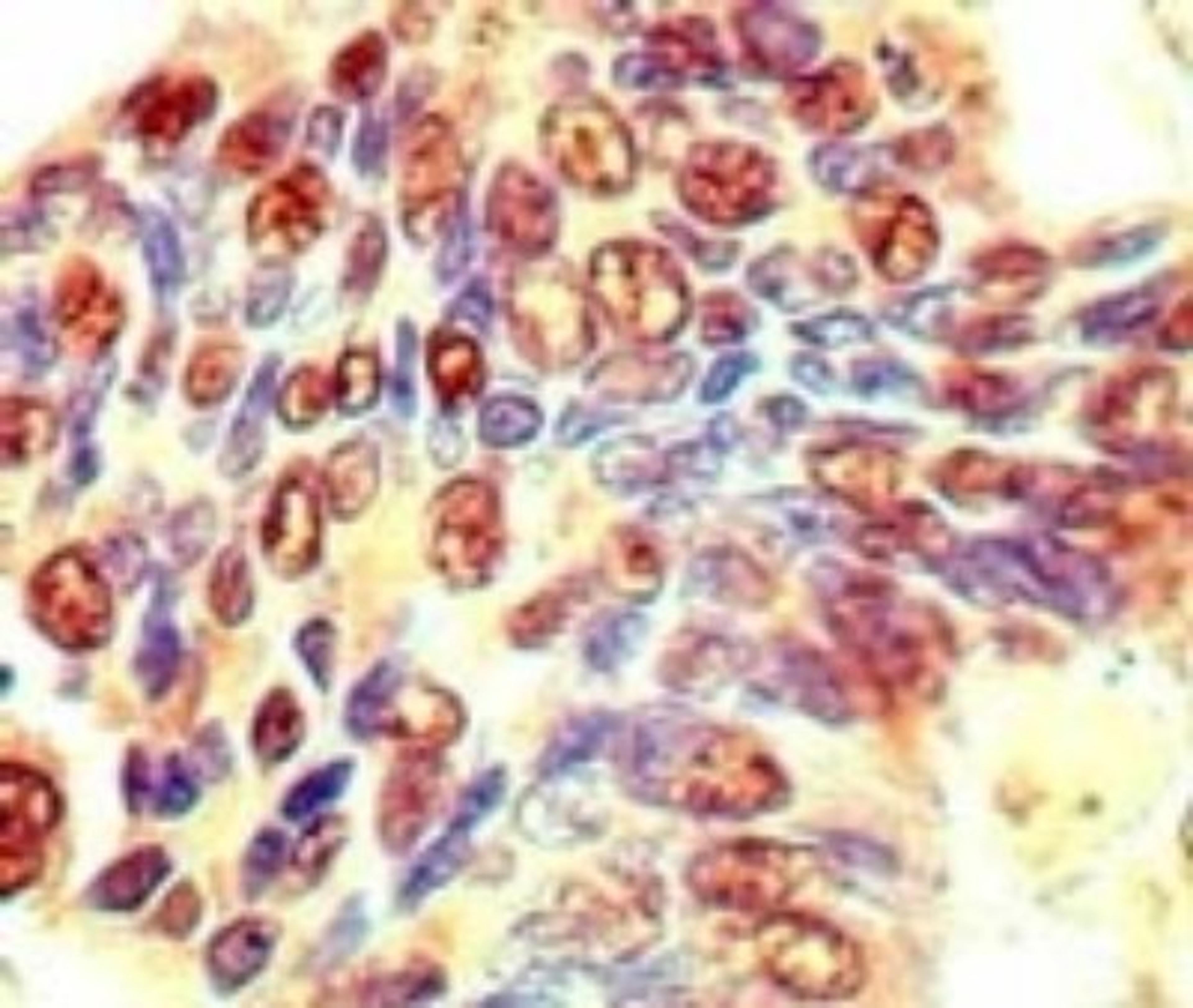 Immunohistochemistry-Paraffin: EIF3J Antibody [NBP2-24572] - IHC testing of human stomach tumor using eIF3J antibody at 5 ug/ml.