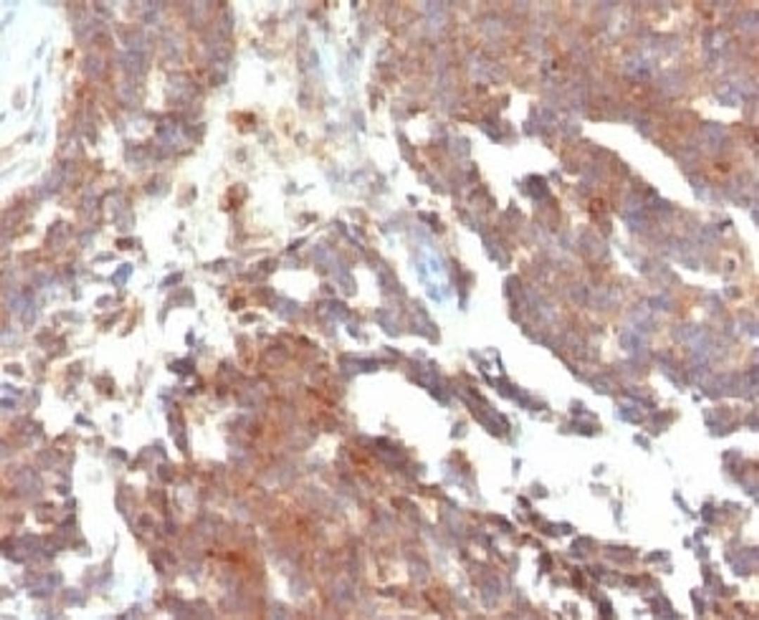 IHC testing of FFPE human ovarian carcinoma and GnRHR antibody (clone LCHR37)