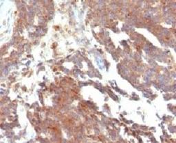 IHC testing of FFPE human ovarian carcinoma and GnRHR antibody (clone LCHR37)