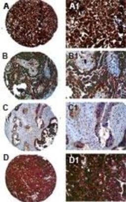 Immunohistochemistry: PTPN13 Antibody [NB100-56139] - IHC of FAP-1 in formalin-fixed, paraffin embedded ovarian carcinoma cores from a tissue microarray at 1:2000. A-D, samples are from four different patients. A1-D1 are high magnification images from A-D, respectively. Hematoxylin-eosin counterstain.