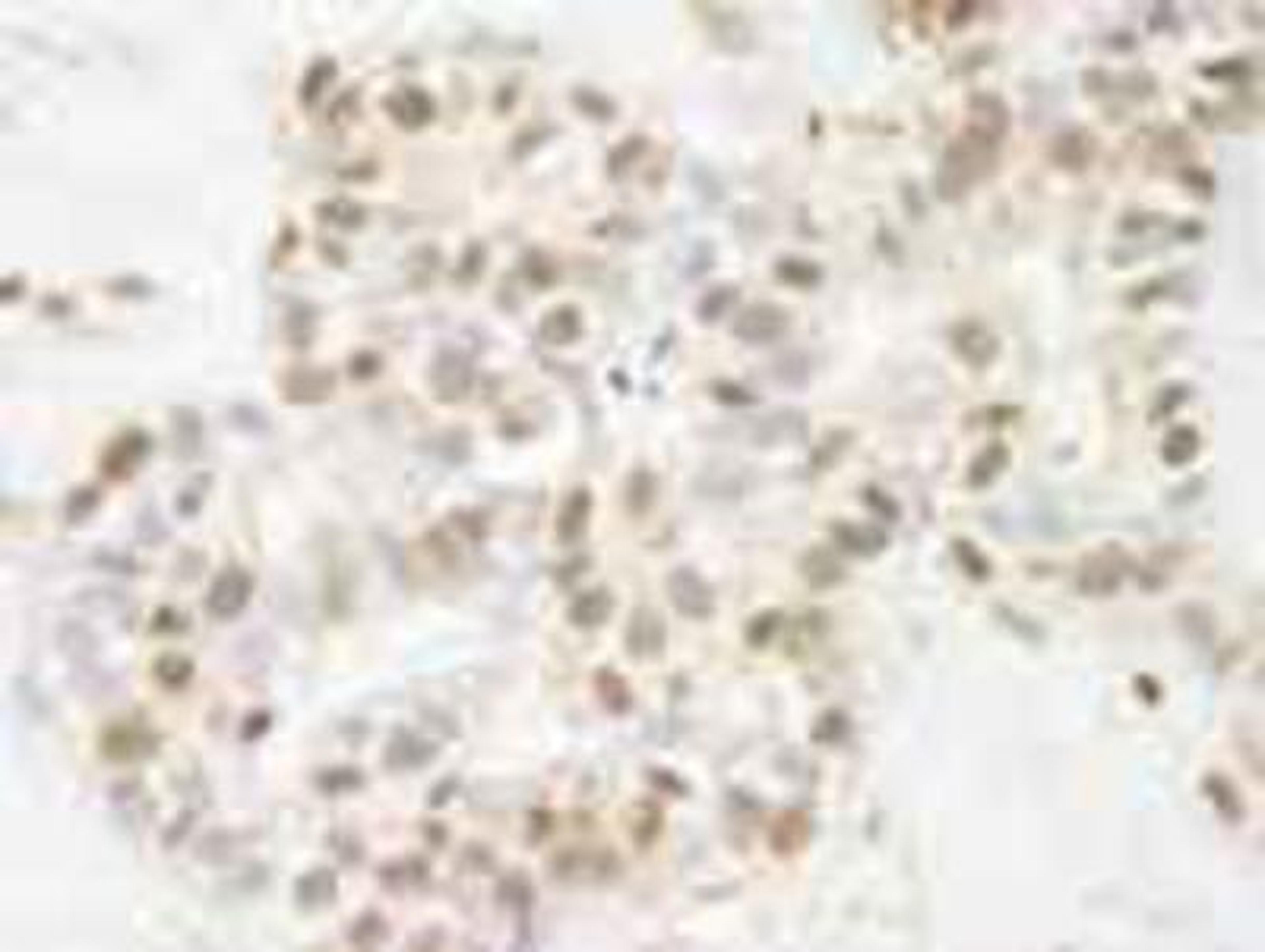 Immunohistochemistry-Paraffin: ARID1B Antibody [NB100-57485] - FFPE section of human breast carcinoma.   Affinity purified rabbit anti-ARID1B used at a dilution of 1:250.