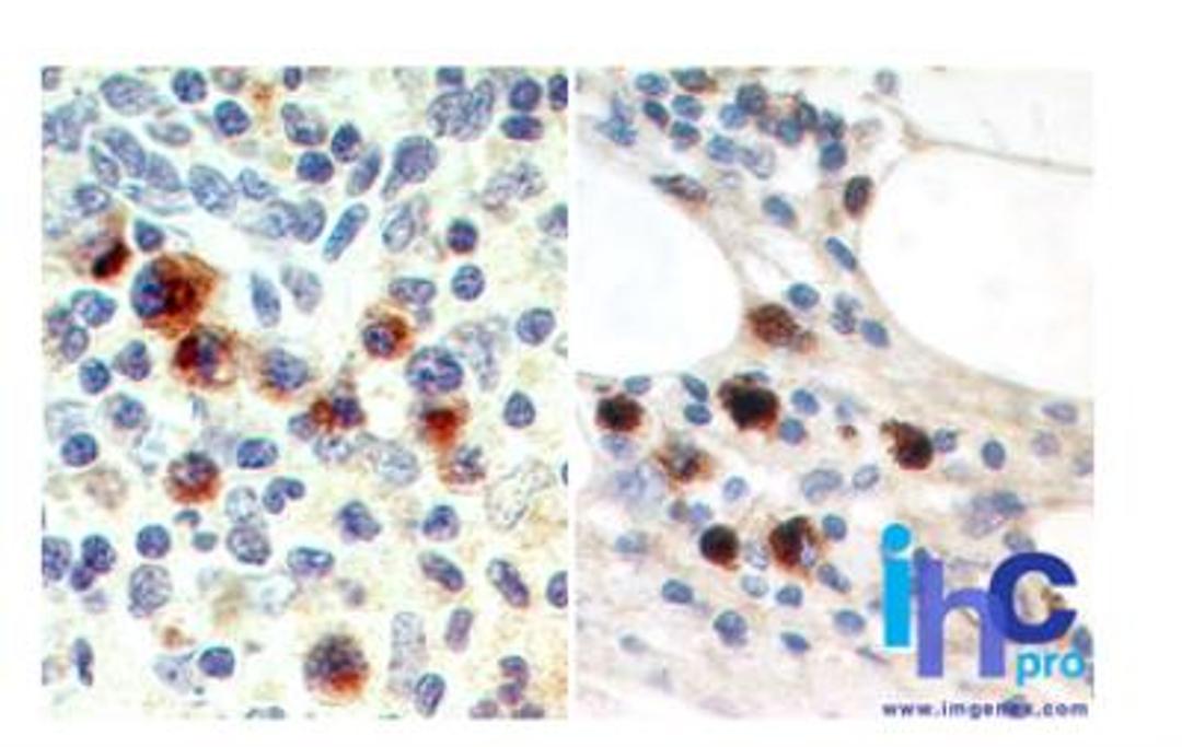 Immunohistochemistry-Paraffin: IL-27/IL-35 EBI3 Subunit Antibody (15k8D10) [NBP2-27362] - Formalin-fixed, paraffin-embedded human spleen (left) and lymph node metastatic malignant melanoma (right) stained with IL-35 antibody (5 ug/ml) using peroxidase-conjugate and DAB chromogen.