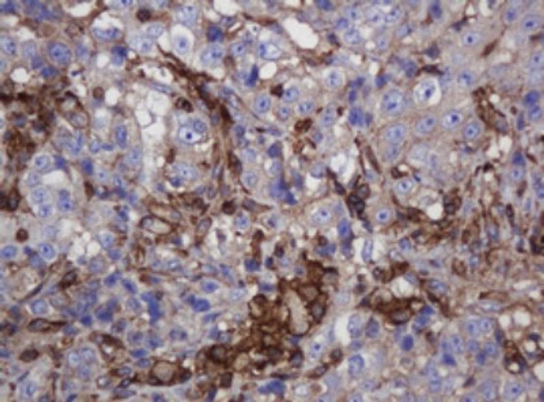 Immunohistochemistry: FNDC4 Antibody (1B7) [NBP2-45691] - Analysis of Adenocarcinoma of Human colon tissue. (Heat-induced epitope retrieval by 10mM citric buffer, pH6.0, 120C for 3min)