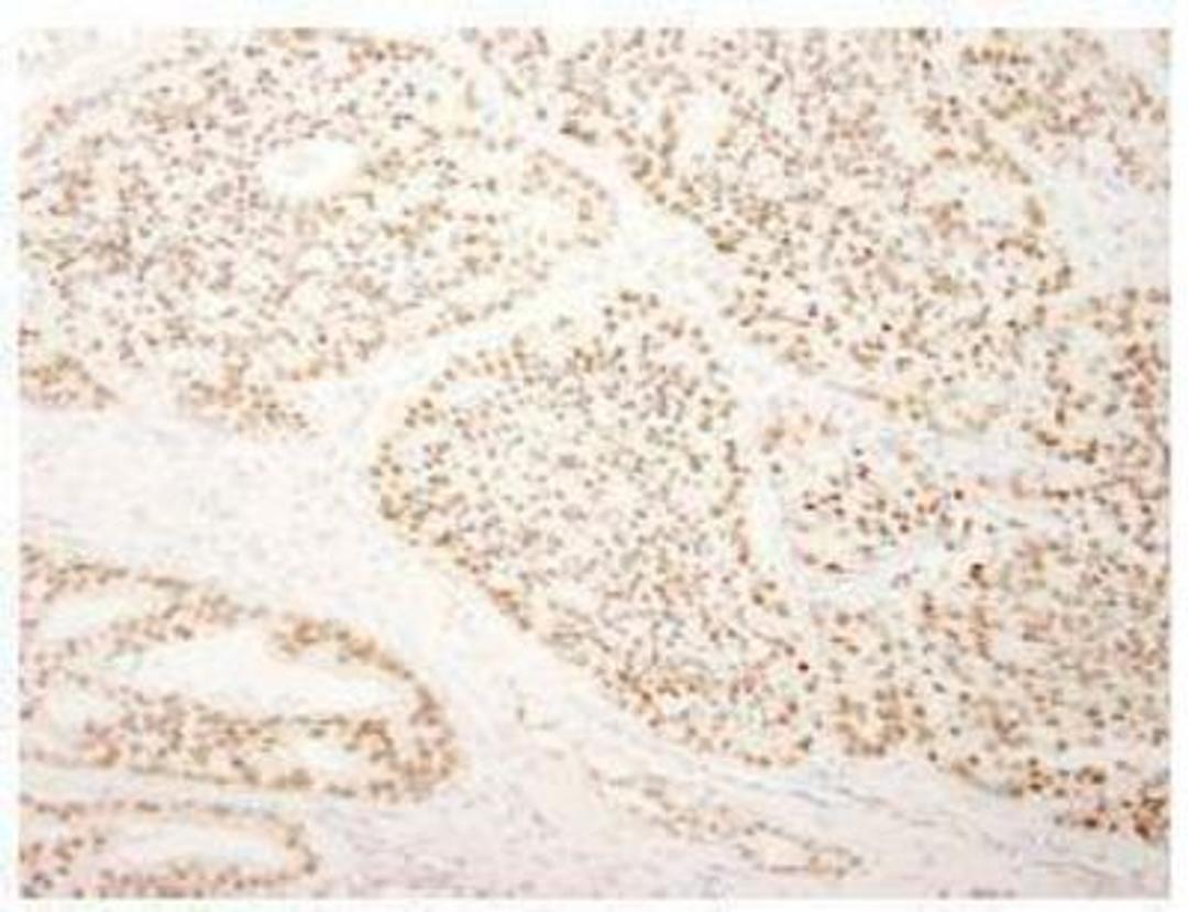 Immunohistochemistry-Paraffin: SFRS14 Antibody [NB100-79849] - FFPE section of human prostate carcinoma.  Affinity purified rabbit anti-SFRS14 used at a dilution of 1:250. Detection: DAB staining using Immunohistochemistry Accessory Kit