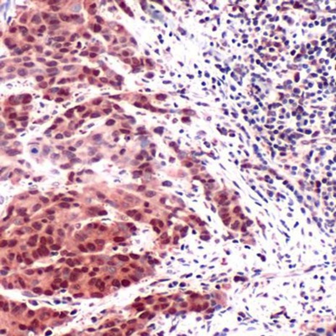 Immunohistochemistry-Paraffin: Thymidylate Synthase Antibody [NBP1-36638] Human Colon Carcinoma.