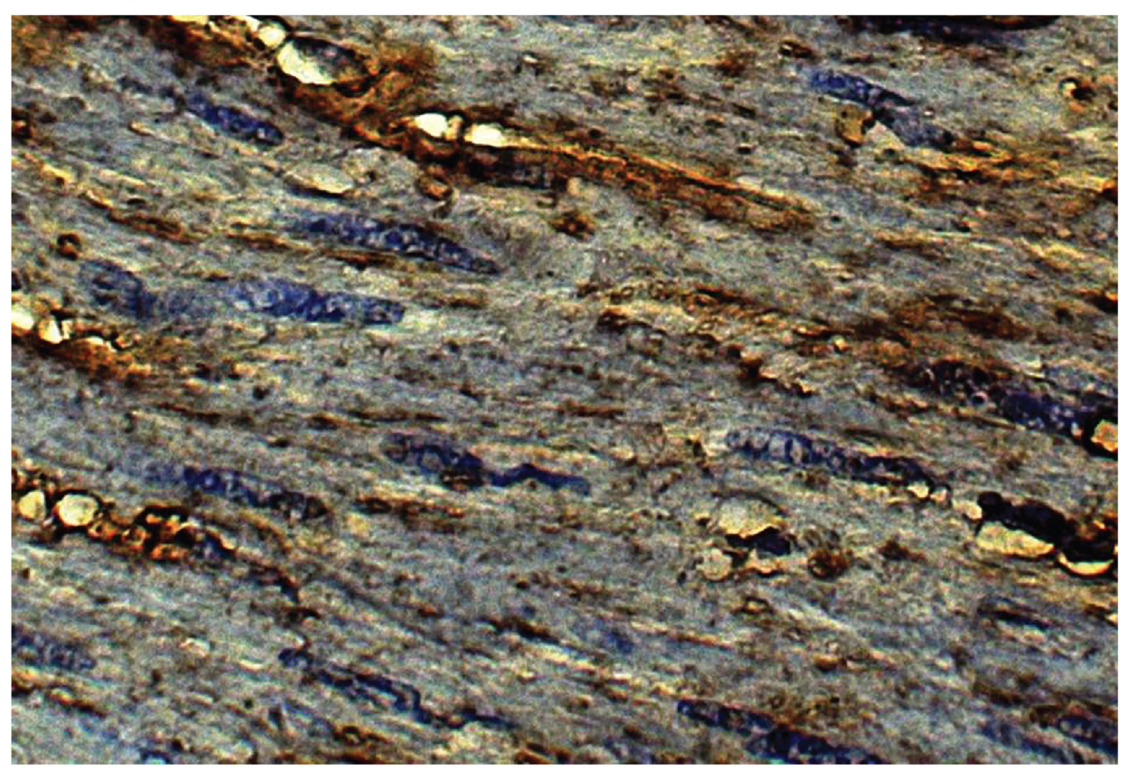 Human kidney cancer tissue was stained with Goat Anti-Type VI Collagen-UNLB (Cat. No. 98-511) followed by Swine Anti-Goat IgG(H+L), Human/Rat/Mouse SP ads-BIOT and Streptavidin-HRP .