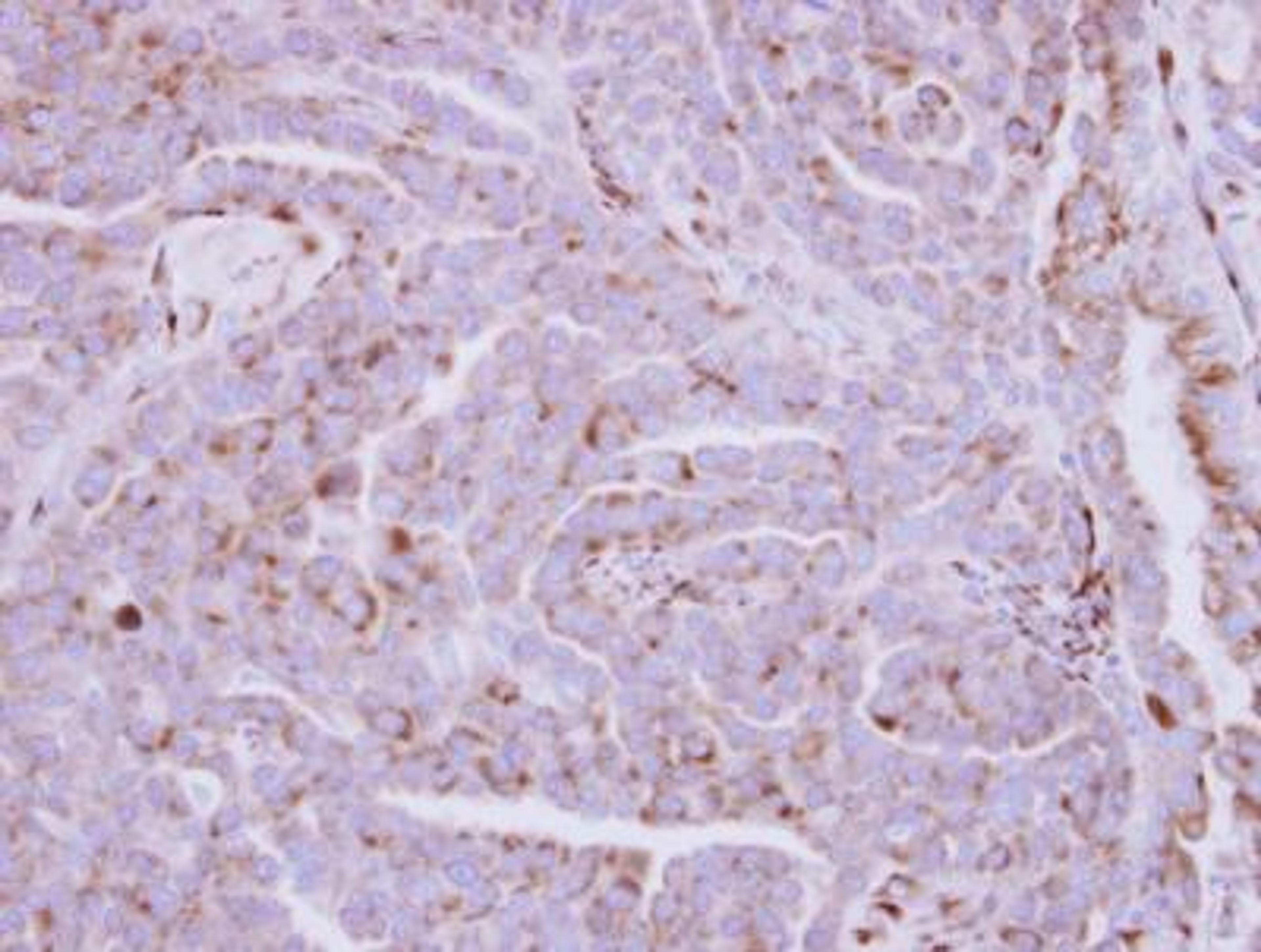 Immunohistochemistry-Paraffin: ZDHHC11 Antibody [NBP2-15166] - Paraffin-embedded Lung Adenocarcinoma,