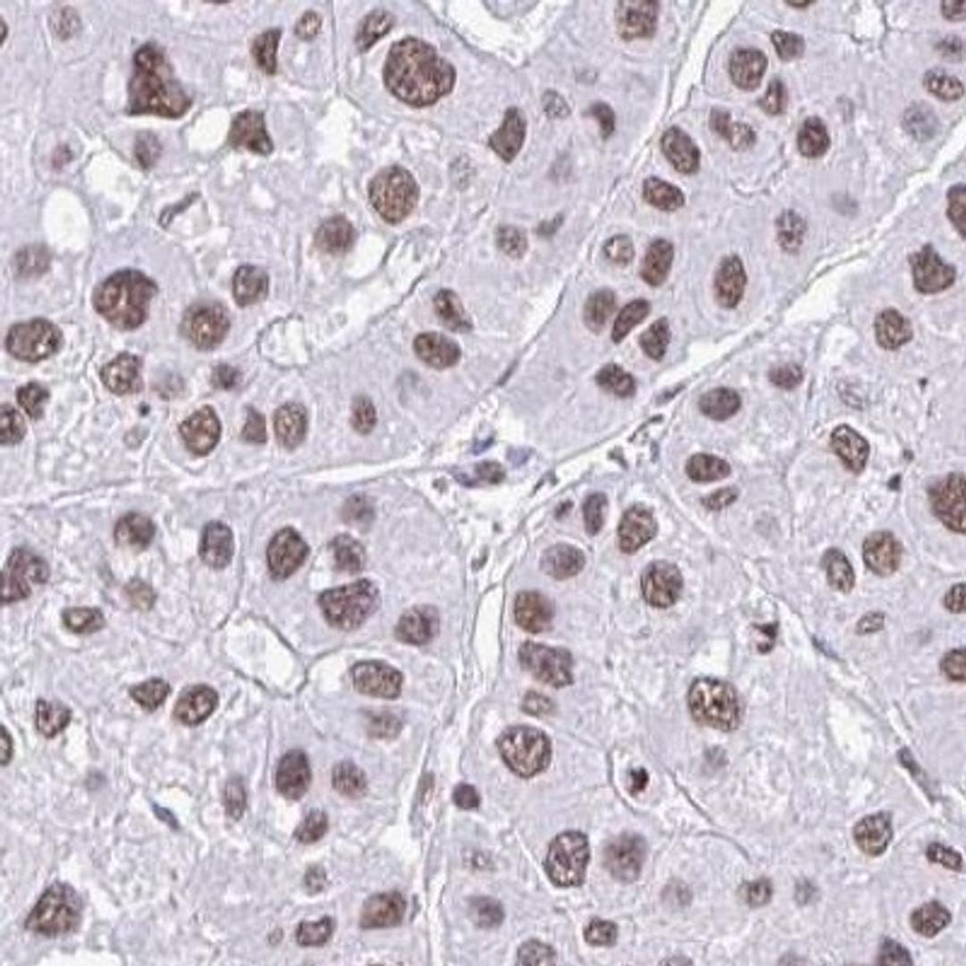 Immunohistochemistry-Paraffin: DDX52 Antibody [NBP2-33776] - liver cancer