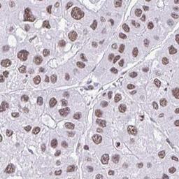 Immunohistochemistry-Paraffin: DDX52 Antibody [NBP2-33776] - liver cancer