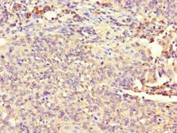 Immunohistochemistry of paraffin-embedded human cervical cancer using CSB-PA896697LA01HU at dilution of 1:100