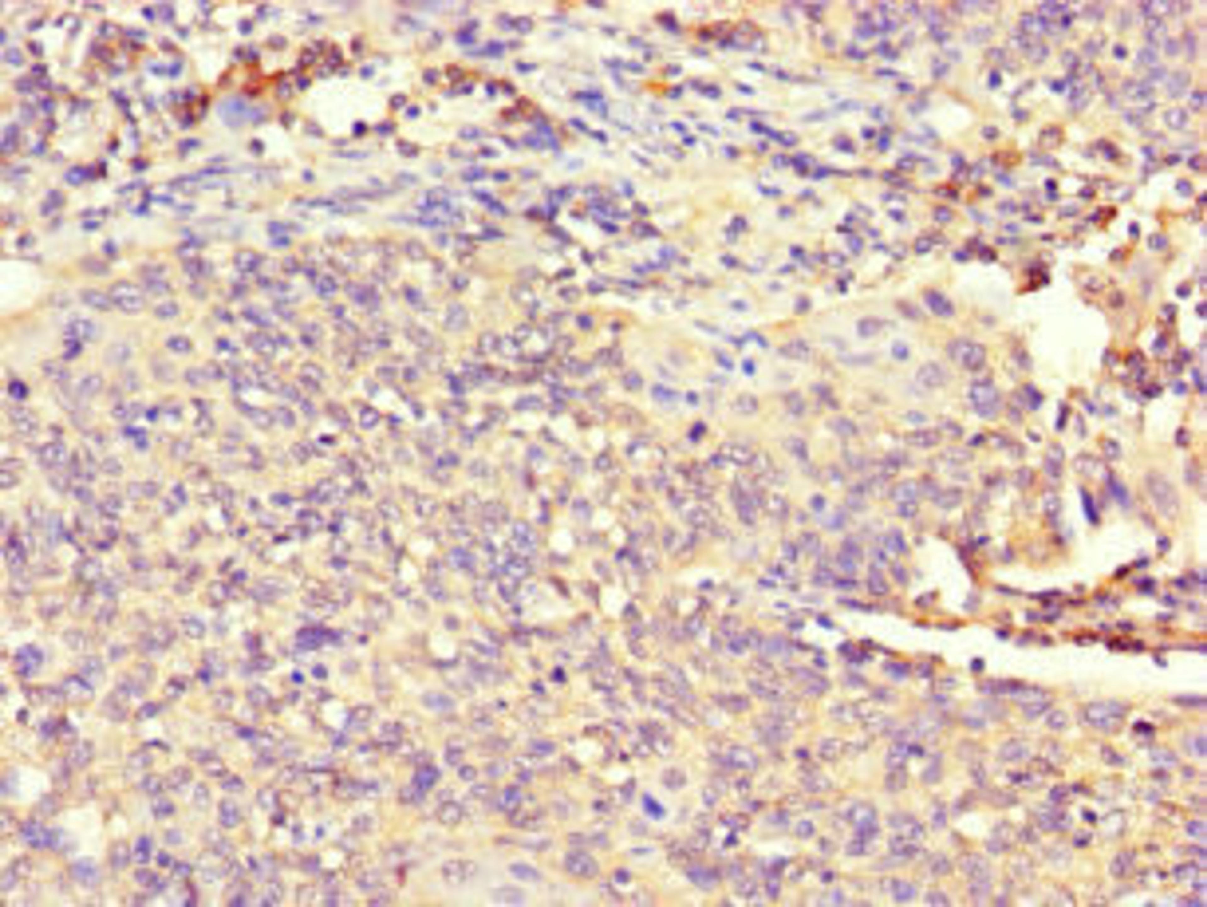 Immunohistochemistry of paraffin-embedded human cervical cancer using CSB-PA896697LA01HU at dilution of 1:100