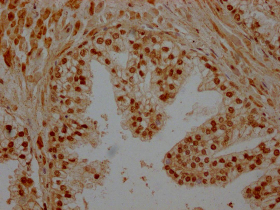 IHC image of CSB-PA851527LA11HU diluted at 1:200 and staining in paraffin-embedded human prostate cancer performed on a Leica BondTM system. After dewaxing and hydration, antigen retrieval was mediated by high pressure in a citrate buffer (pH 6.0). Section was blocked with 10% normal goat serum 30min at RT. Then primary antibody (1% BSA) was incubated at 4°C overnight. The primary is detected by a Goat anti-rabbit polymer IgG labeled by HRP and visualized using 0.05% DAB.