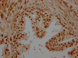 IHC image of CSB-PA851527LA11HU diluted at 1:200 and staining in paraffin-embedded human prostate cancer performed on a Leica BondTM system. After dewaxing and hydration, antigen retrieval was mediated by high pressure in a citrate buffer (pH 6.0). Section was blocked with 10% normal goat serum 30min at RT. Then primary antibody (1% BSA) was incubated at 4°C overnight. The primary is detected by a Goat anti-rabbit polymer IgG labeled by HRP and visualized using 0.05% DAB.