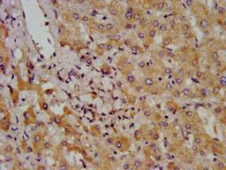 IHC image of CSB-PA883427LA01HU diluted at 1:800 and staining in paraffin-embedded human liver cancer performed on a Leica BondTM system. After dewaxing and hydration, antigen retrieval was mediated by high pressure in a citrate buffer (pH 6.0). Section was blocked with 10% normal goat serum 30min at RT. Then primary antibody (1% BSA) was incubated at 4&deg;C overnight. The primary is detected by a biotinylated secondary antibody and visualized using an HRP conjugated SP system.